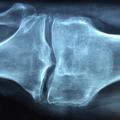 Osteoporoza – podstępna choroba cywilizacyjna