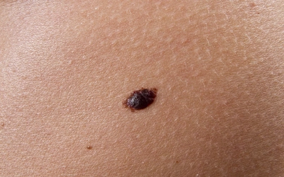Rak skóry błędnie kojarzony jest głównie z czerniakiem