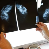 Onkolog: pandemia zaciągnęła w onkologii dług zdrowotny, z którym długo będziemy się borykać